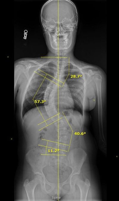 Azalya Phelps spine xray 3.3.25 with measurements